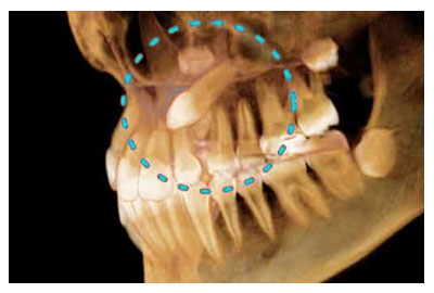 Dientes retenidos