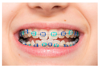 Caries y empaste dental