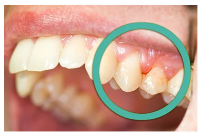 Gingivitis