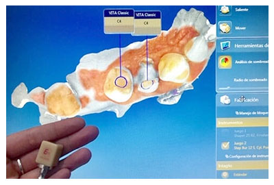 Tecnología CEREC